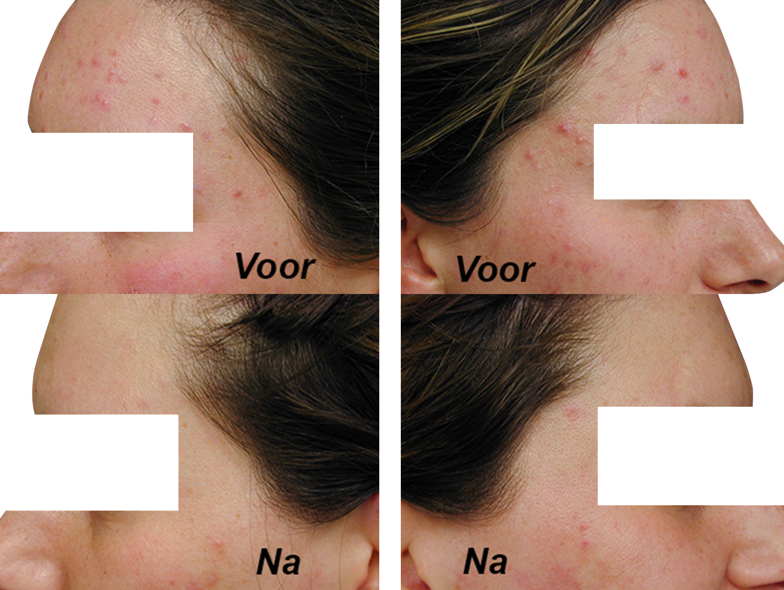 Acnetherapie
