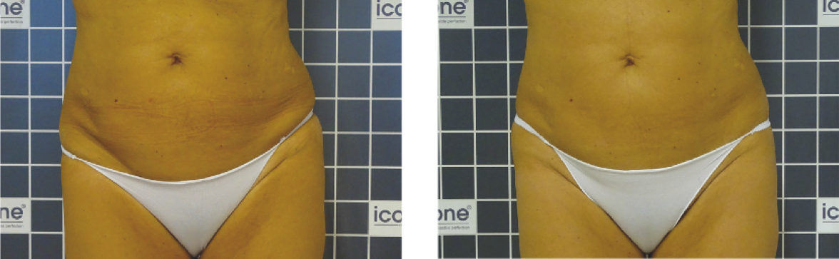 icoone® LASER - voor en na lichaam20