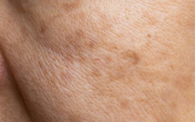 Waarom krijgt de ene huid pigmentvlekken en de andere niet?