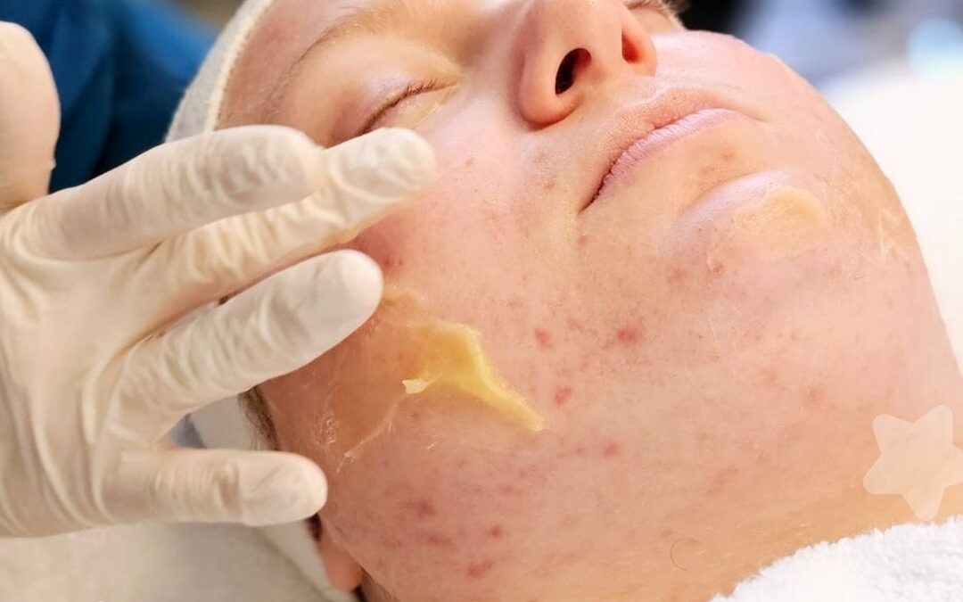 Acne op volwassen leeftijd: waarom je huid ineens verandert