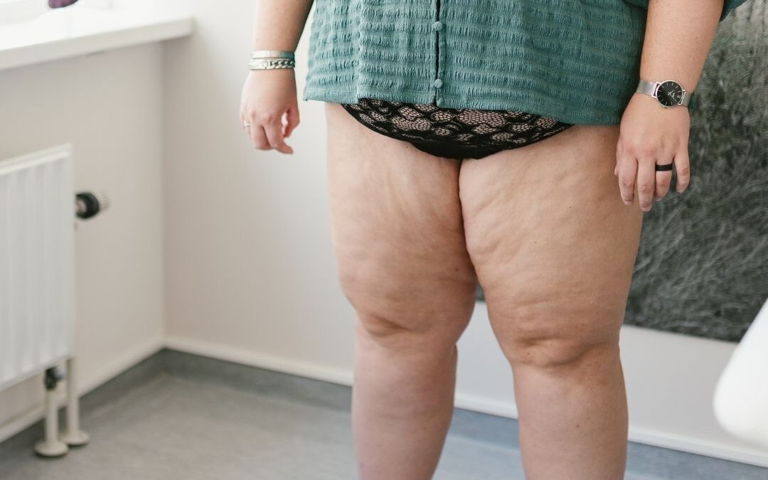 Lipoedeem: Begrip voor je lichaam