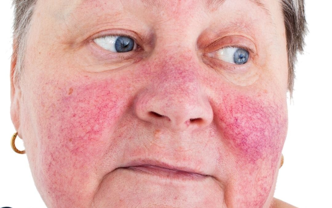 Rosacea: wat is het en wat kun je eraan doen?