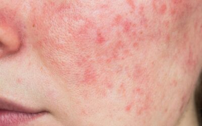 Rosacea of acne: hoe herken je het verschil?